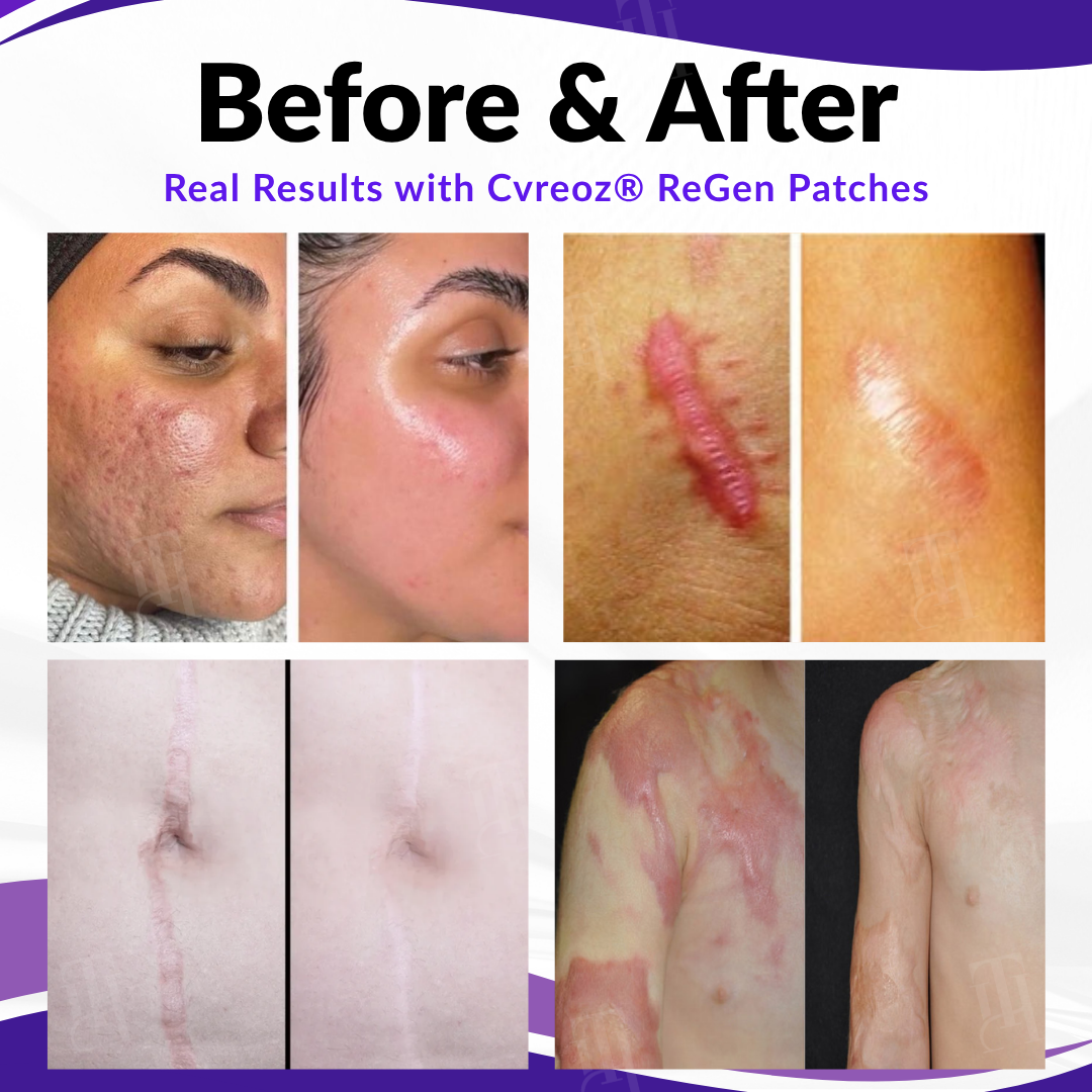 Cvreoz® ReGen Microneedles Pro Patches
